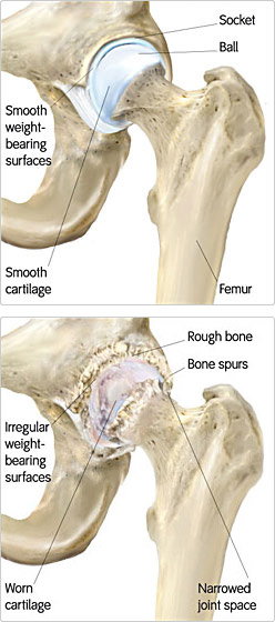 Osteoarthritis Diagram