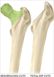 Bone Conservation