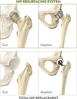 Hip Resurfacing vs. Hip Replacement