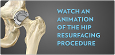 Watch an animation of the hip resurfacing procedure